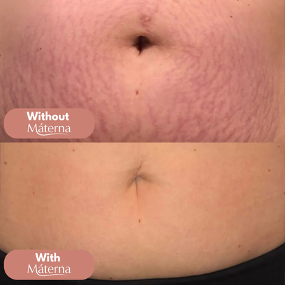 Silicone StretchMark Prevention Pack™