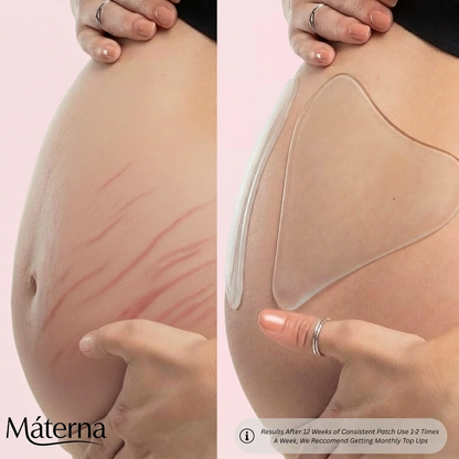 Silicone StretchMark Pack